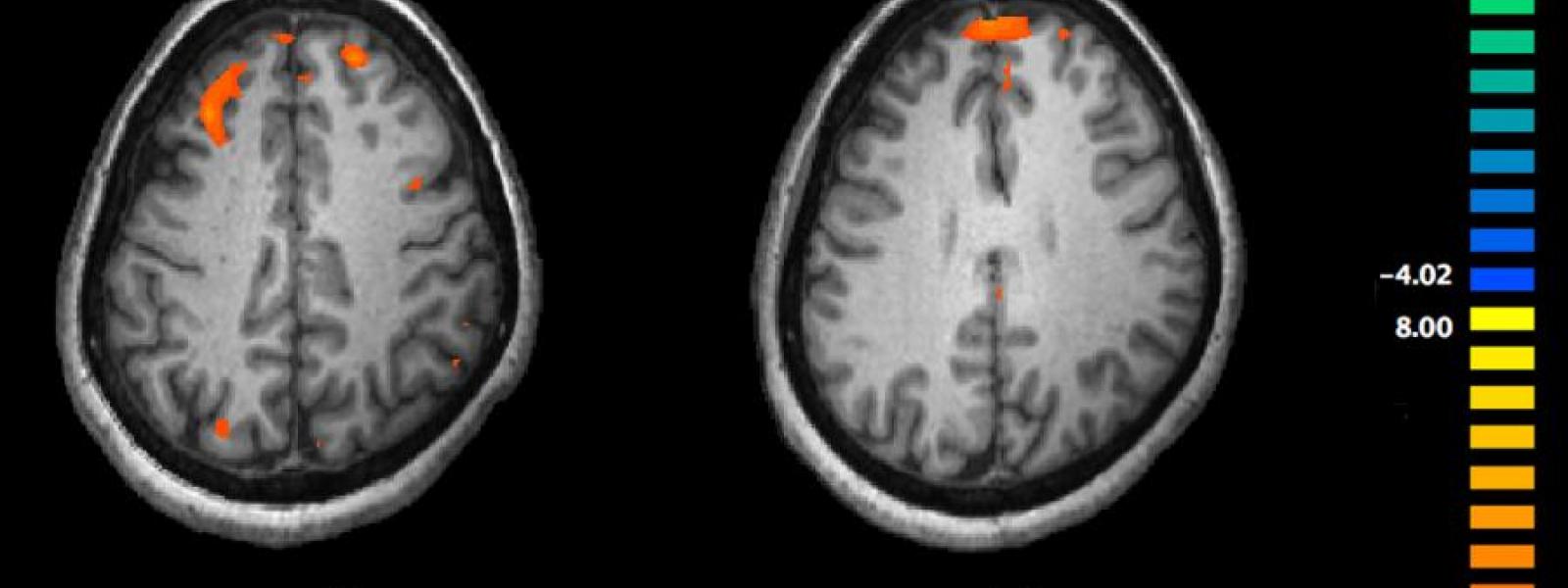 Key Brain Activity Absent in Borderline Personality Disorder - Neuroscience  News